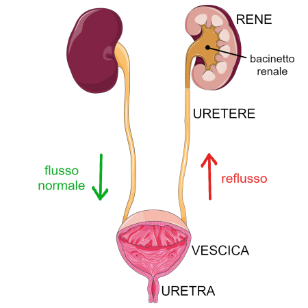 apparato urinario reflusso vescico-ureterale